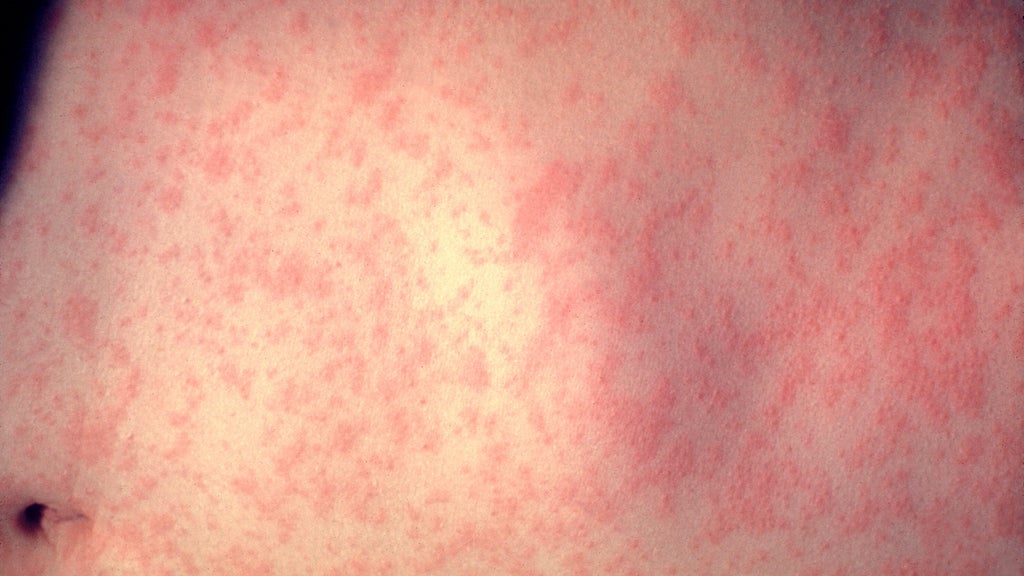 25 cases of measles identified in central, southeastern Minnesota, MDH says — WCCO / CBS Minnesota, Marco Island Health news