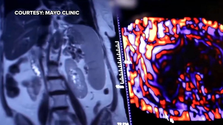Healthy SA: Battling liver cancer, a disease which often has no symptoms early on — KENS 5 (San Antonio), Marco Island Health news